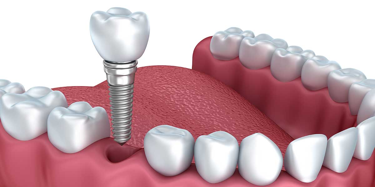 Dental Fillings and Implants