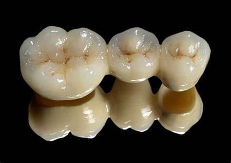 Crowns and Bridges
